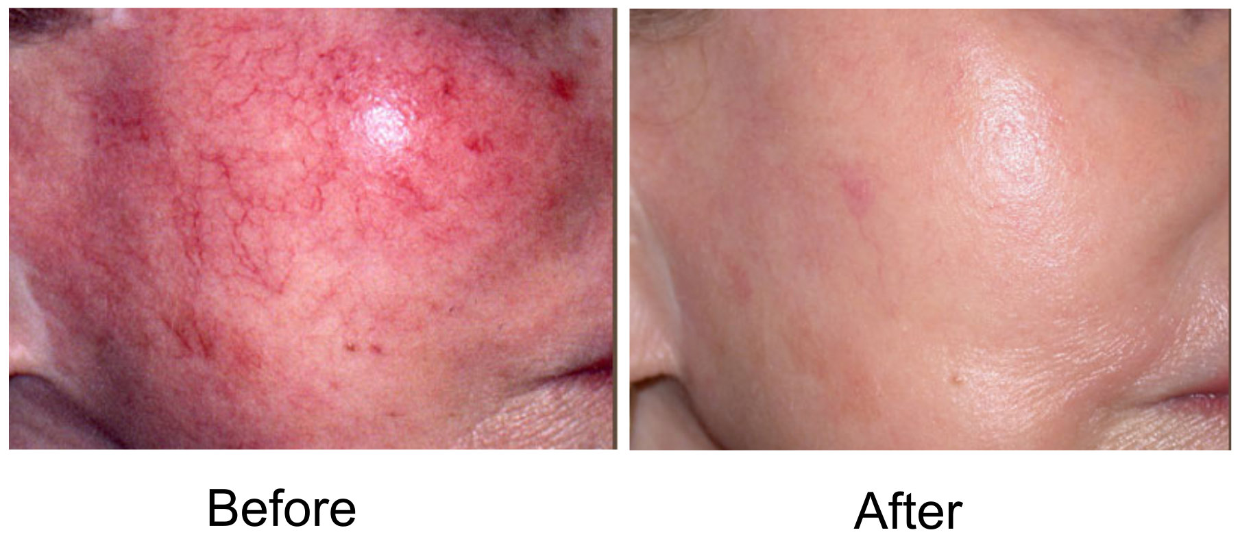 veins-ipl.jpg