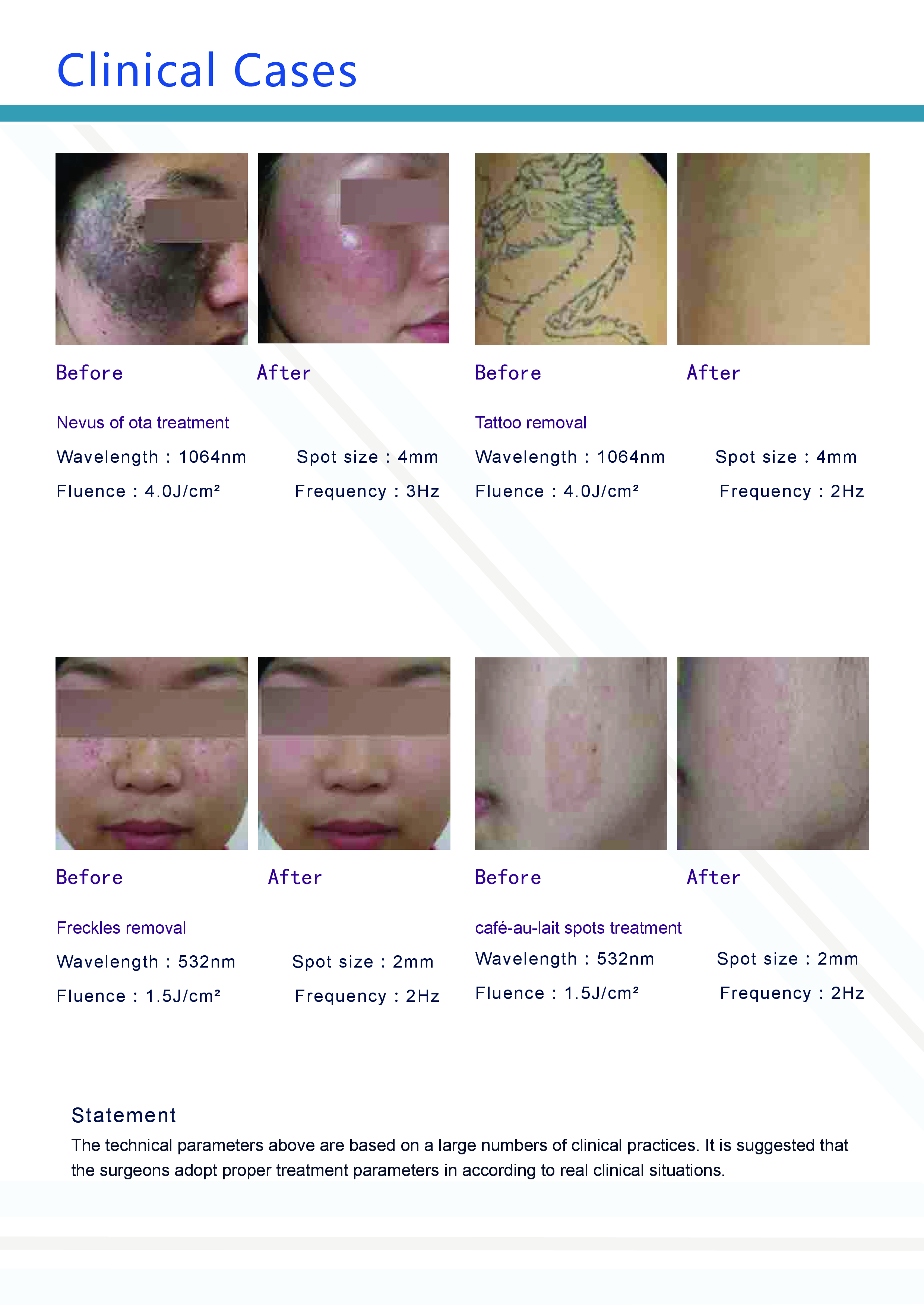 EXQ NdYAG Laser brochure 4 .png